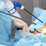 Laparoscopic Bariatric Surgeries