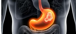 Gastrointestinal doctor in Dombivli